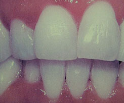 gum care after image