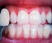 home-teeth-whitening-after