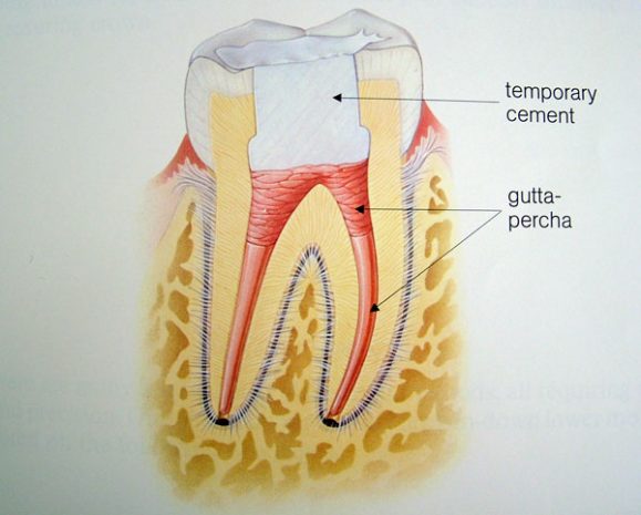 rootcanal_filling_3
