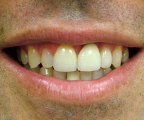 cosmetic-dentist-dentures_after