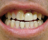 cosmetic-dentist-dentures_before