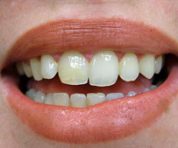 cosmetic-dentist-gum-lift_after